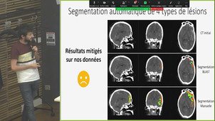 GRICAD : Segmentation d’images CT de patients traumatisés crânien
