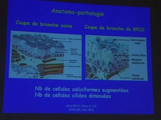 Activités physiques et maladie respiratoire chronique (P. Flore) - 2003