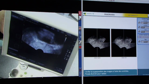 INNOVATIONS DANS LES GMCAO (GESTES MÉDICO-CHIRURGICAUX ASSISTÉS PAR ORDINATEUR) - Partie 3/3